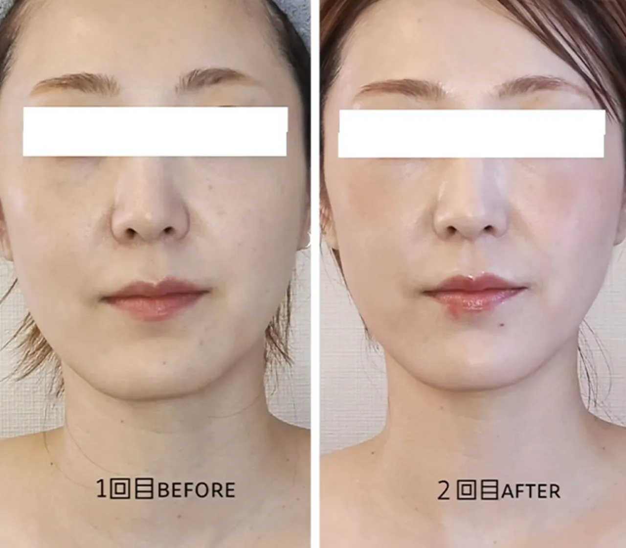 BEFORE AFTER